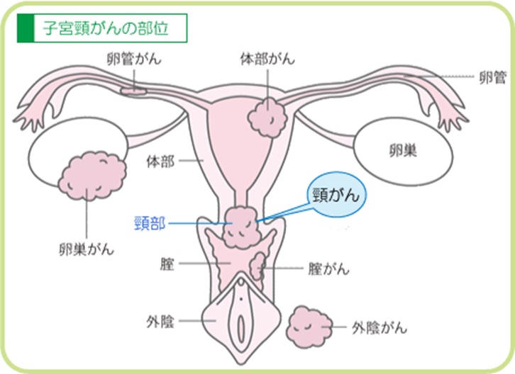 子宮癌